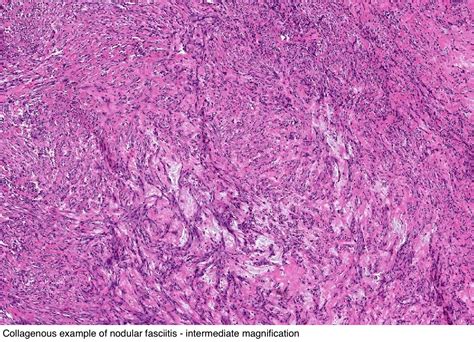 Pathology Outlines - Nodular fasciitis