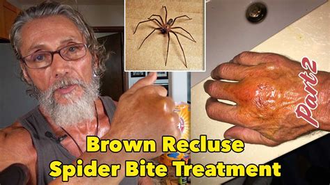 Brown Recluse Spider Bite Stages