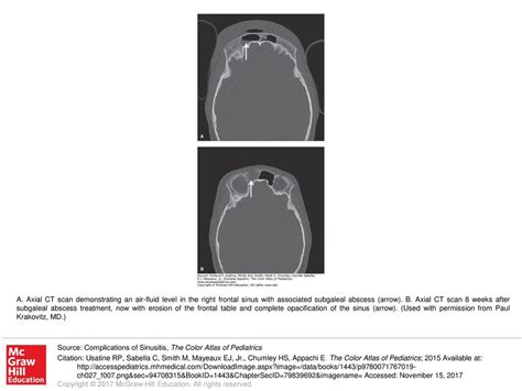 A. Axial CT scan demonstrating an air-fluid level in the right frontal ...