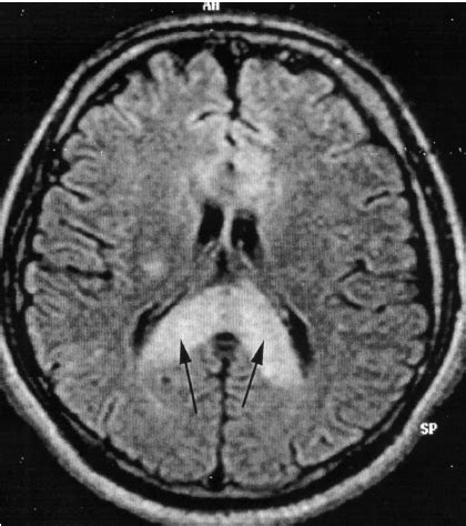 MRI showing marked swelling and hyperintense posterior body and... | Download Scientific Diagram