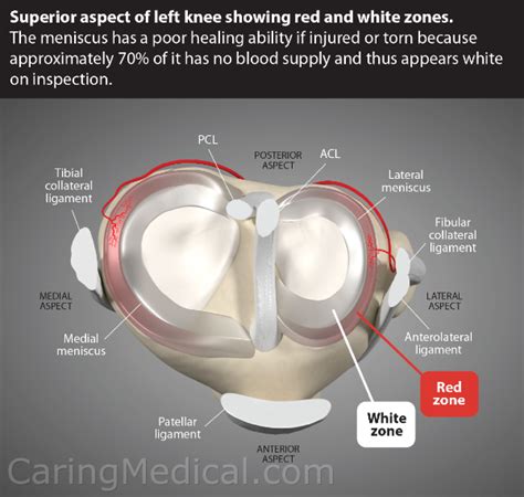 Should I have meniscus surgery? Meniscus tear and repair in the adult ...