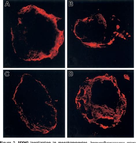 Figure 2 from for the phenotypes in May-Hegglin anomaly / Fechtner ...