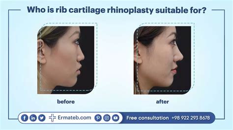 RIB Cartilage Rhinoplasty, How, Risks, Costs | Ermateb