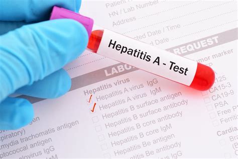 10 Things to Know About Hepatitis A (Symptoms, Causes, and More ...