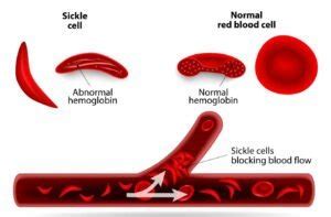 Treatment of Sickle Cell Anemia in Delhi