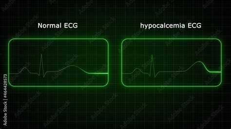 The ECG hallmark of hypocalcemia remains the prolongation of the ...