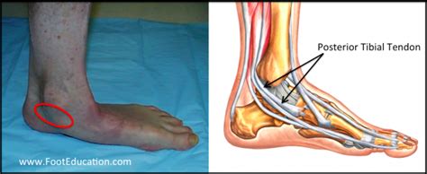 Acquired Adult Flatfoot Deformity - FootEducation