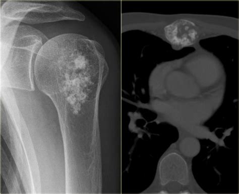 Рак Кости Плечевого Сустава Симптомы И Лечение