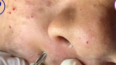 TOP (BLACKHEADS REMOVAL} - YouTube