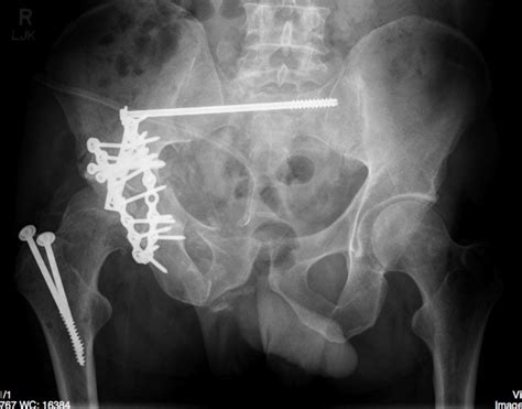 Pelvic Fracture – Undergraduate Diagnostic Imaging Fundamentals