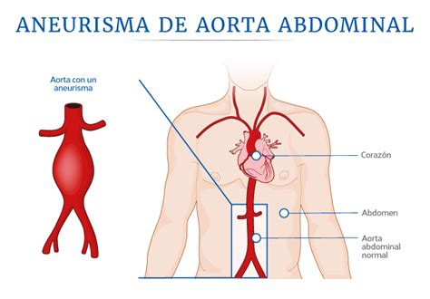 Médica Sur: Aneurisma de aorta abdominal