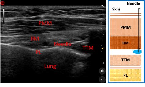 Example picture and ultrasound image of deep parasternal intercostal... | Download Scientific ...