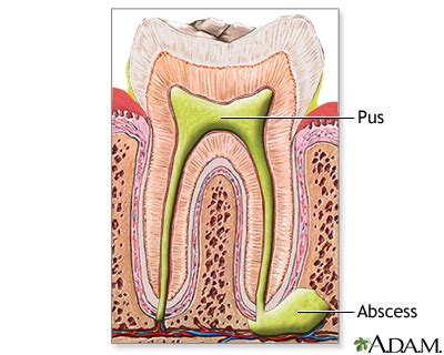 Tooth abscess Information | Mount Sinai - New York