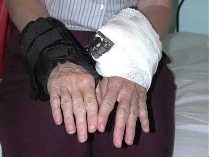 Minimally Invasive Hand and Wrist Surgery