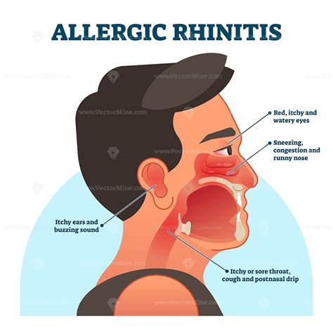 Allergic rhinitis medical diagram, vector illustration labeled information | Allergic rhinitis ...