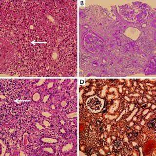 The hallmarks of AIN. AIN with prominent interstitial inflammation ...