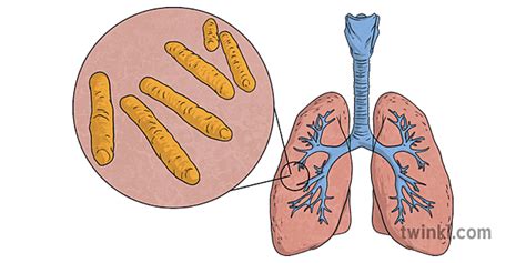 Tuberculosis Bacteria Illustration - Twinkl