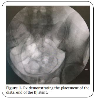 Double J stent migration in the contralateral ureter during robotassisted pyeloplasty: an unique ...