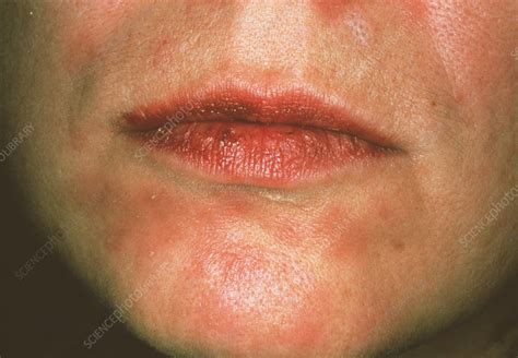 Secondary syphilis rash - Stock Image - M862/0055 - Science Photo Library