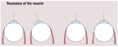 Squint Surgery in India Best Squint surgery Hospitals India Cost