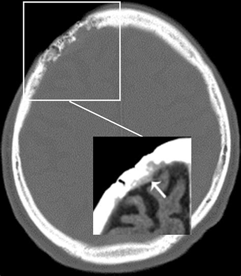 Imaging Spectrum of Calvarial Abnormalities | RadioGraphics