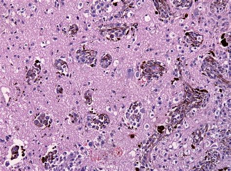 Immunotherapy Boosts Survival Rates of Melanoma Brain Metastases’ Patients