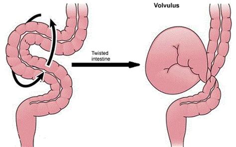 Bowel Obstruction - Small & Large - Causes, Symptoms, Treatment