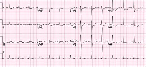 Dr. Smith's ECG Blog: A Picture of Subendocardial Ischemia