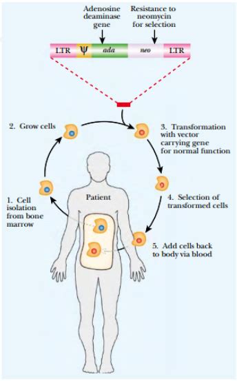 Retrovirus Gene Therapy for SCID - Study Solutions