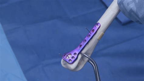 Arthrex - OrthoLine™ Distal Humeral Fracture System: Sawbone Application on a Canine Elbow ...