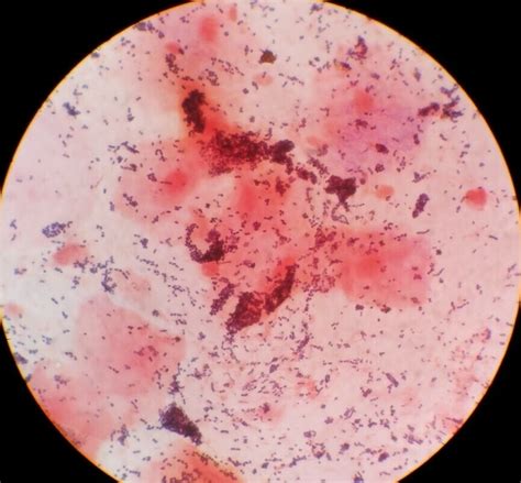 Sputum gram stain » Clinical Laboratory Science