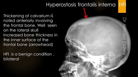 case 608 Hyperostosis frontalis interna HFI - YouTube