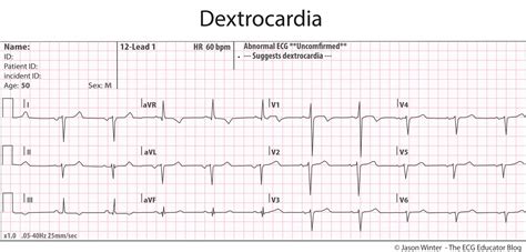 ECG Educator Blog : Dextrocardia