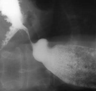 Esophageal Motility Disorders: Background, Etiopathophysiology ...