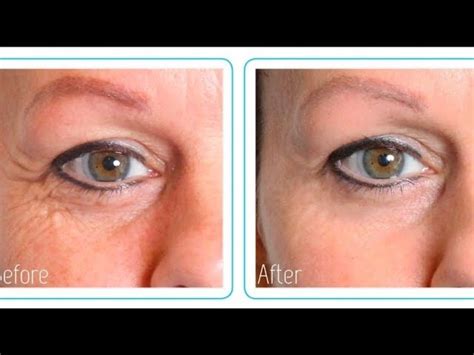 Hyaluronic Acid Before And After (MY RESULTS!)