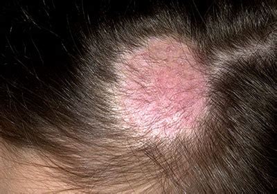 Hair Loss and Demodex Mites | Ungex | Demodex Treatment