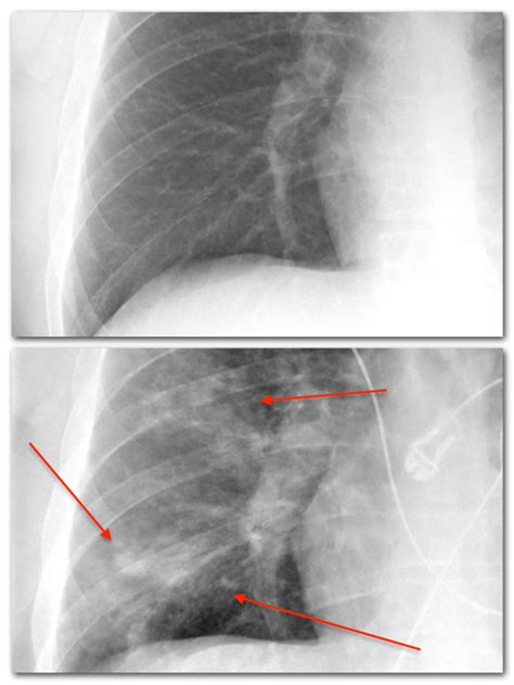 Language of the Chest X-ray | Neighborhood Radiologist