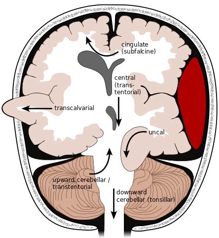 Increased Intracranial Pressure (ICP) | Concise Medical Knowledge | Neurology, Medical anatomy ...