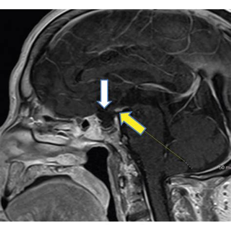 MRI brain with contrast showing empty sella with complete absence of... | Download Scientific ...