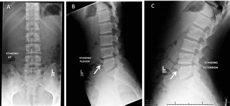 Cureus | Limbus Vertebra