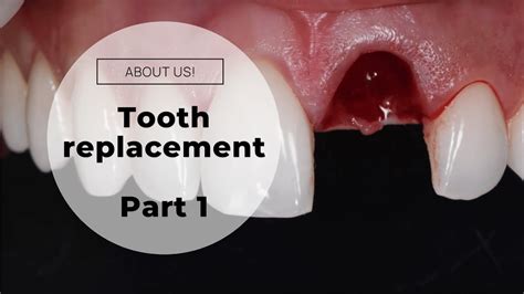 DENTAL IMPLANT (Graphic images - Dentist) - Immediate front tooth replacement Part 1 (Surgery ...