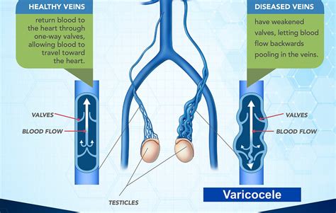 Varicocele Embolization: Day-care treatment for varicocele; a silent cure for male infertility ...