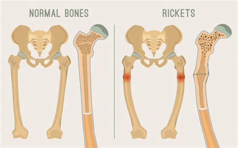 Royalty Free Rickets Disease Clip Art, Vector Images & Illustrations ...