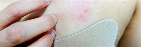 What Does a Breast Cancer Rash Look Like? | BASS Cancer Center