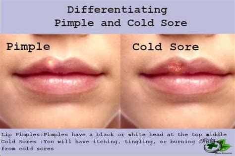 How to Get Rid of a Pimple on Lip?: Best 9 Remedies