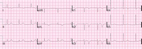 Dr. Smith's ECG Blog: Wellens' syndrome, no culprit, what happened?