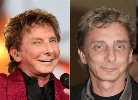 Barry Manilow before and after plastic surgery – Celebrity plastic ...