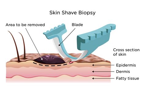 Skin Biopsy