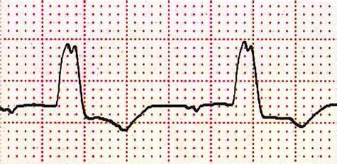 Level 7 - EKG - Memrise