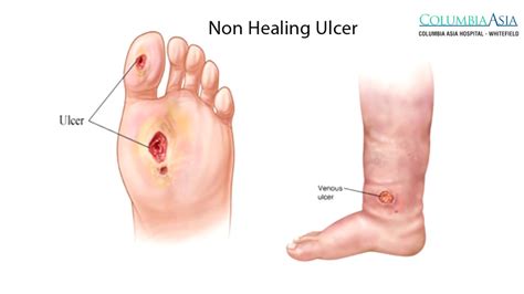 How To Cure Diabetic Ulcers - DiabetesWalls